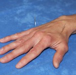 hand met naalden1